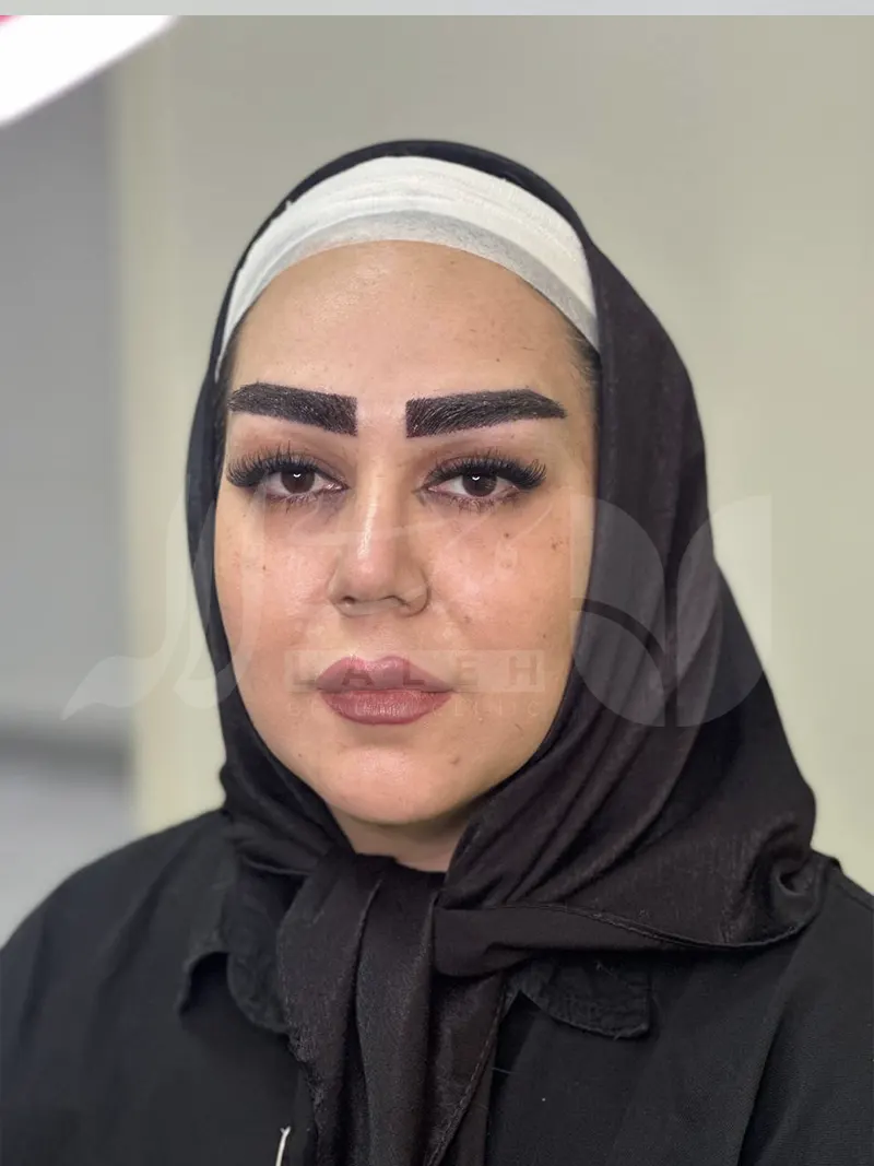 عکس کاشت ابرو در کلینیک لاله