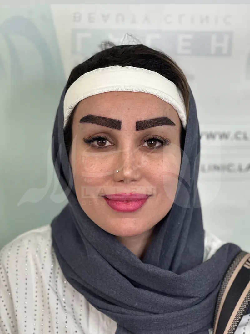 عکس کاشت ابرو در کلینیک لاله