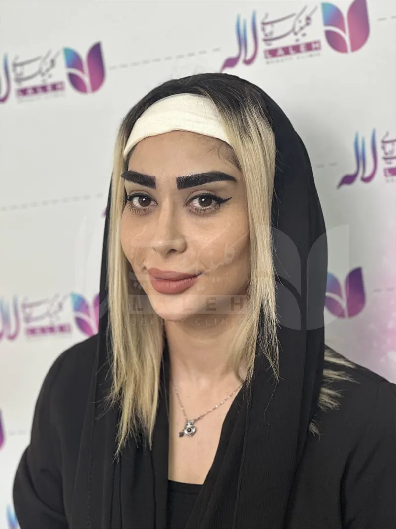 عکس کاشت ابرو در کلینیک لاله