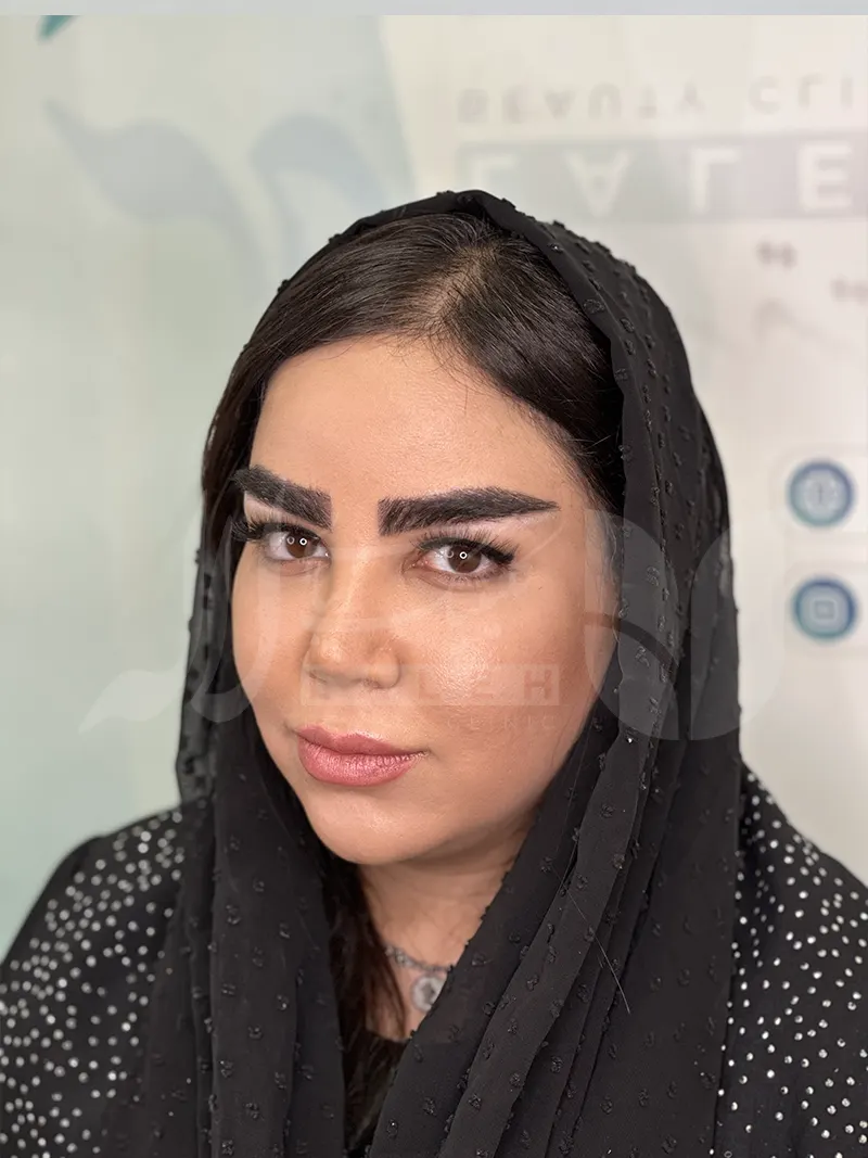 عکس کاشت ابرو در کلینیک لاله