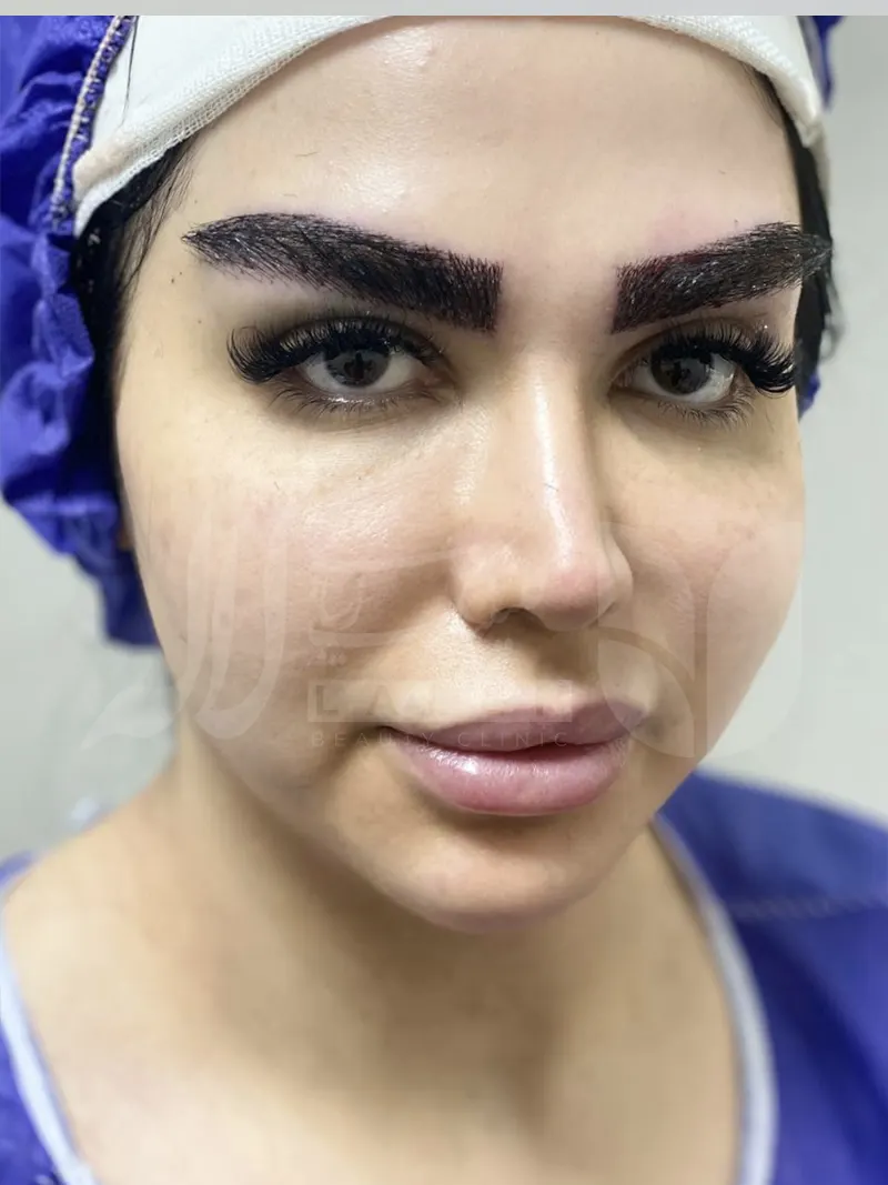 کاشت ابرو پهن