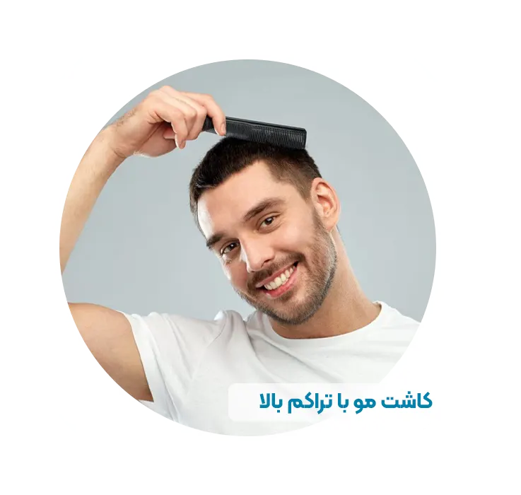 کاشت مو با تراکم بالا