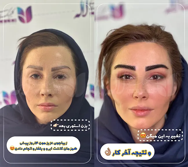 بلفاروپلاستی