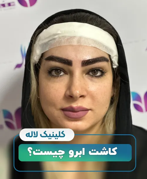 کاشت ابرو چیست
