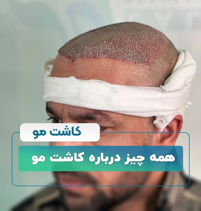 کاشت مو
