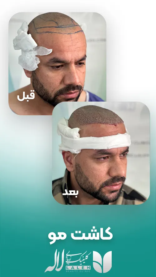قبل و بعد کاشت مو