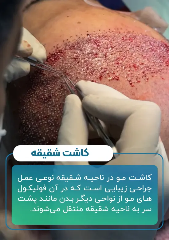 کاشت شقیقه