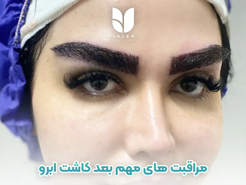 لیست جامع مراقبت های بعد کاشت ابرو