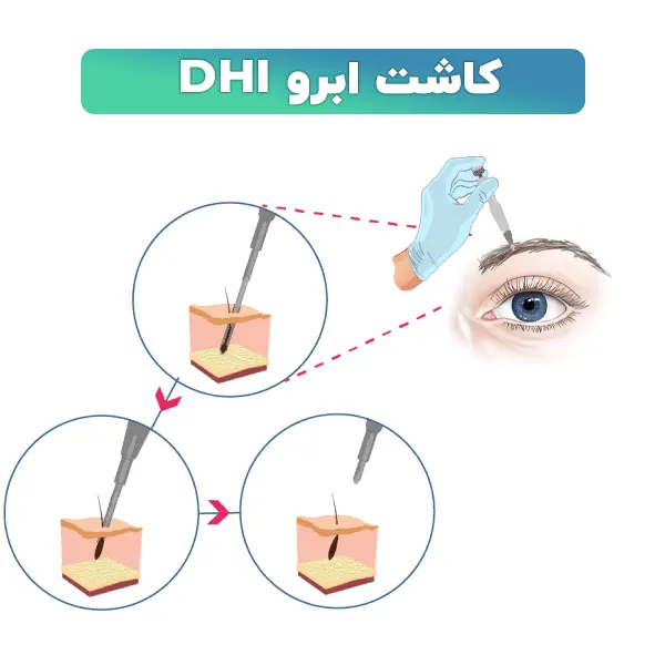 کاشت ابرو DHI