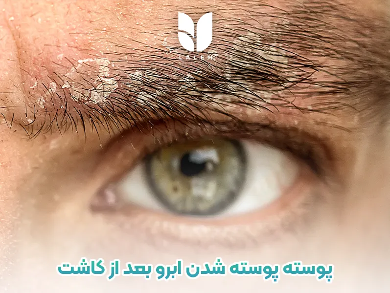 پوسته پوسته شدن ابرو بعد از کاشت ابرو