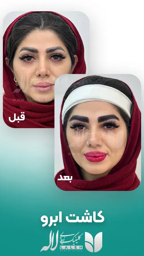 قبل و بعد کاشت ابرو