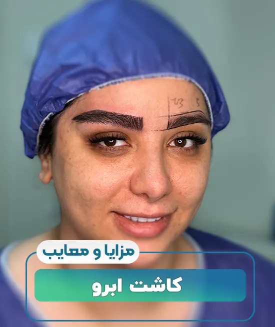 مزایا و معایب کاشت ابرو