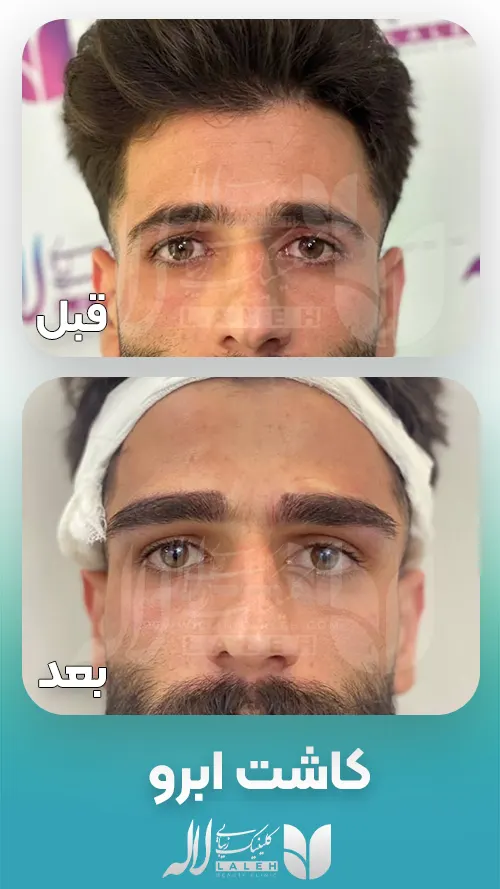 کاشت ابرو در آقایان