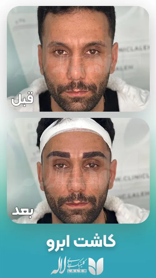 کاشت ابرو در آقایان قبل و بعد