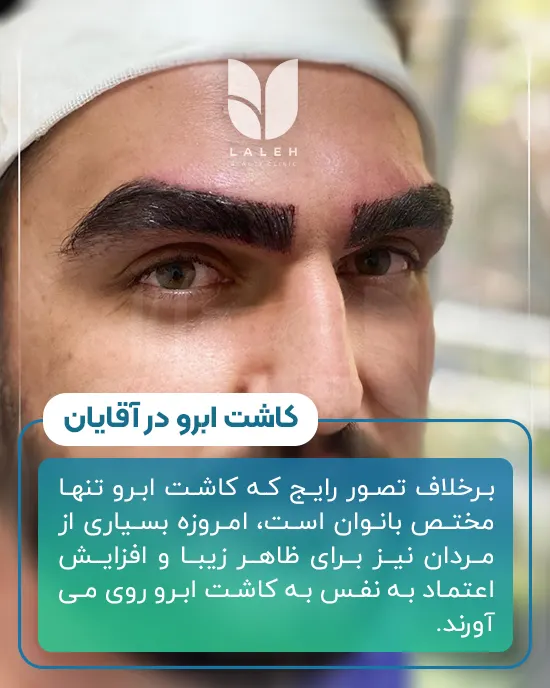 کاشت ابرو در آقایان