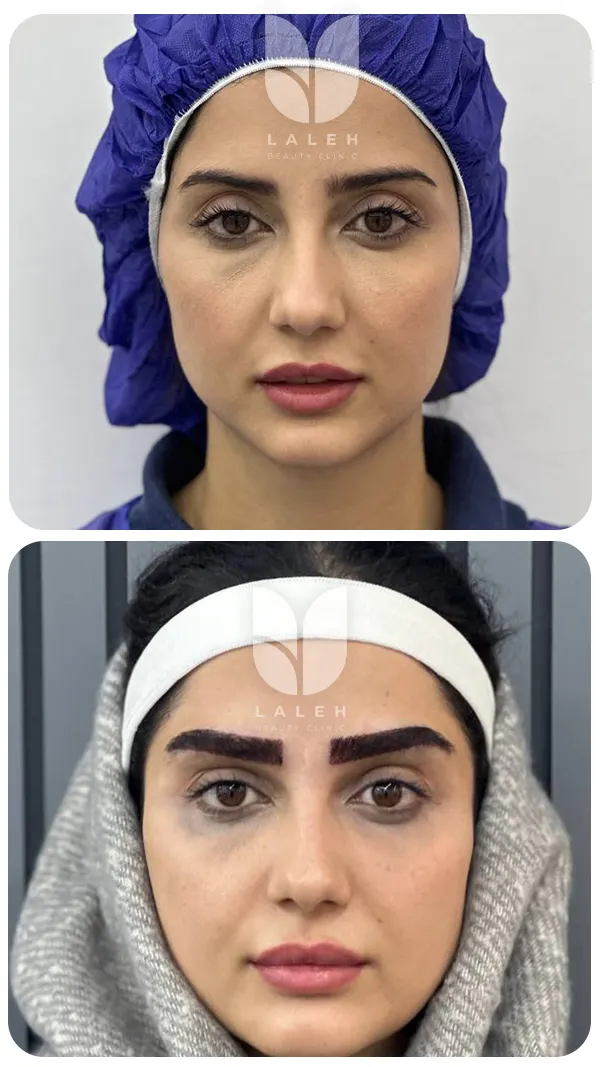 قبل و بعد کاشت ابرو
