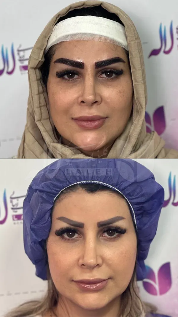 قبل و بعد کاشت ابرو