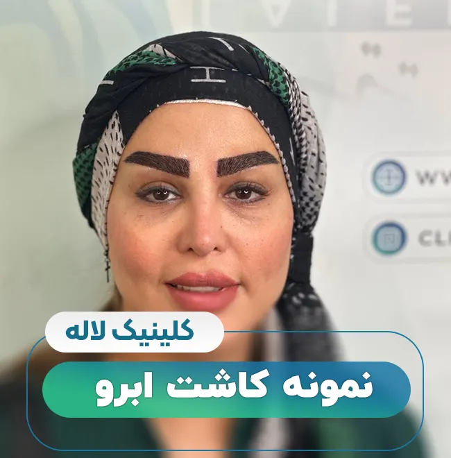 نمونه کاشت ابرو