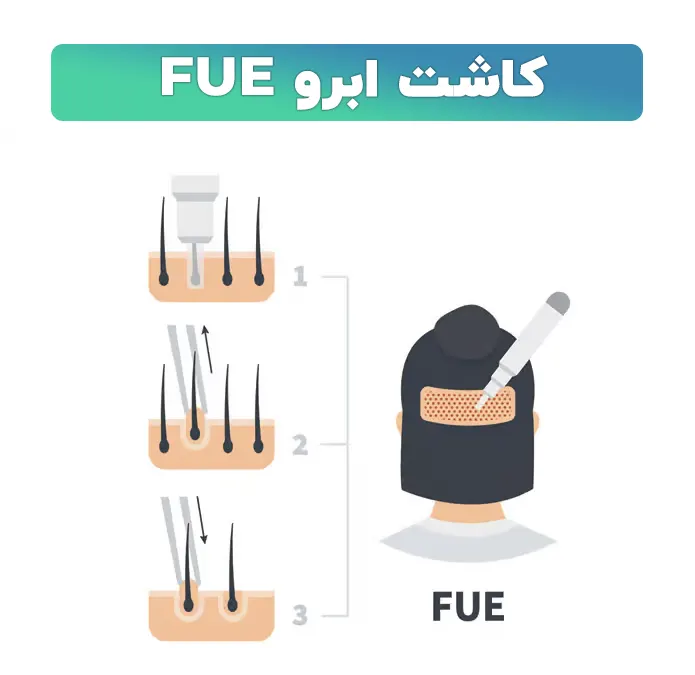 کاشت ابرو FUE