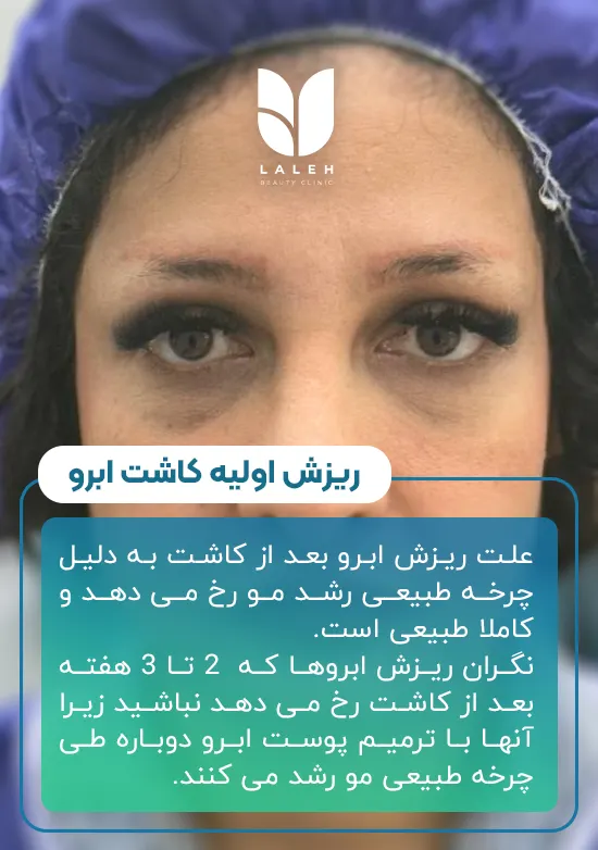 علت ریزش اولیه ابرو بعد از کاشت