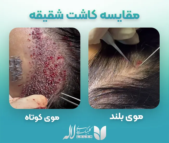 مقایسه کاشت شقیقه با موی بلند و کوتاه