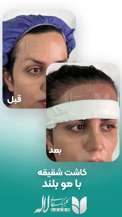 کاشت شقیقه با موی بلند