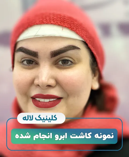 کاشت ابرو