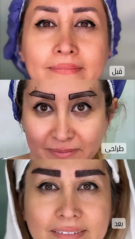 کاشت ابرو