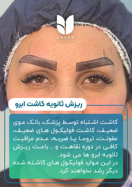 ریزش ثانویه ابروها