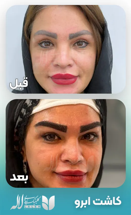 کاشت ابرو