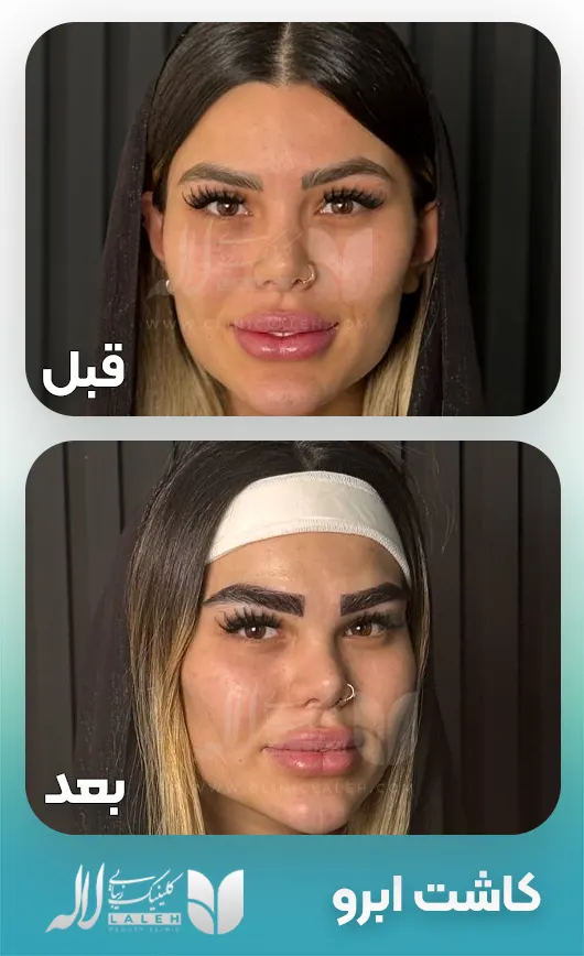 کاشت ابرو