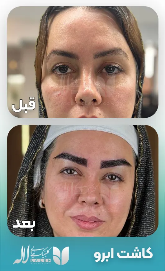 قبل بعد کاشت ابرو