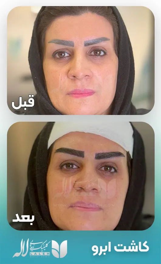 کاشت ابرو قبل بعد