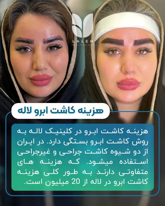 هزینه کاشت ابرو