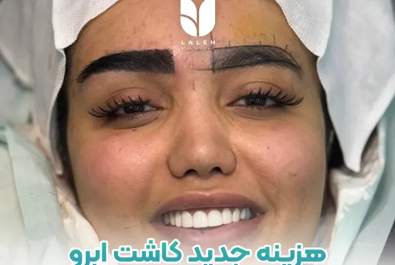 هزینه کاشت ابرو