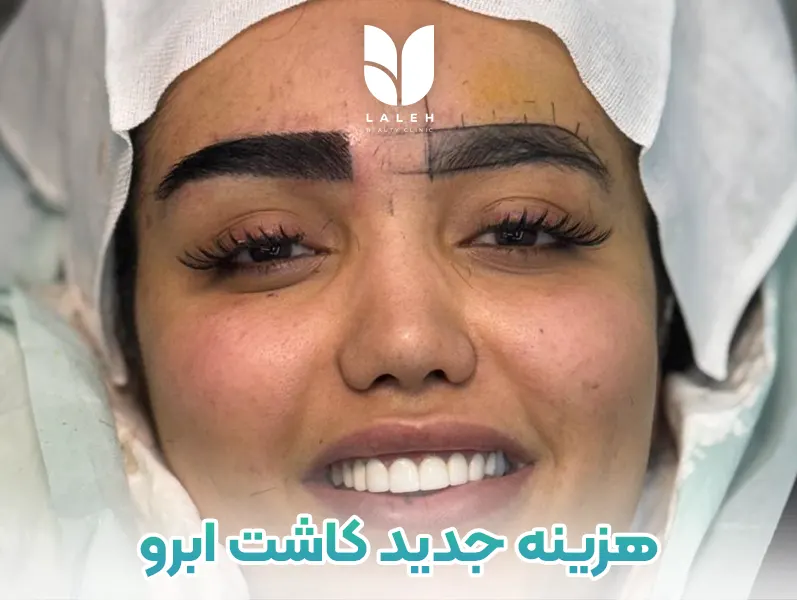 هزینه کاشت ابرو