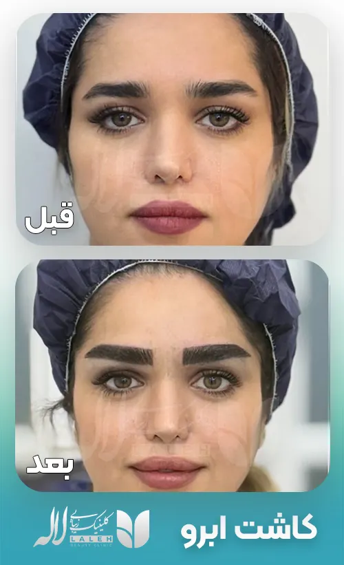 کاشت ابرو قبل بعد