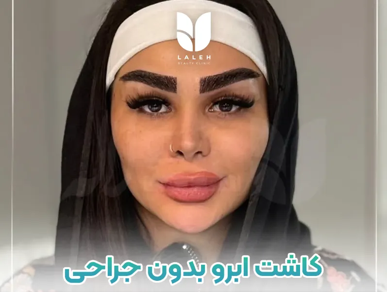 کاشت ابرو بدون جراحی