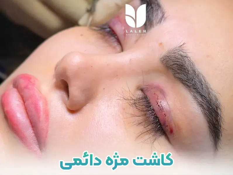 جراحی کاشت مژه دائمی