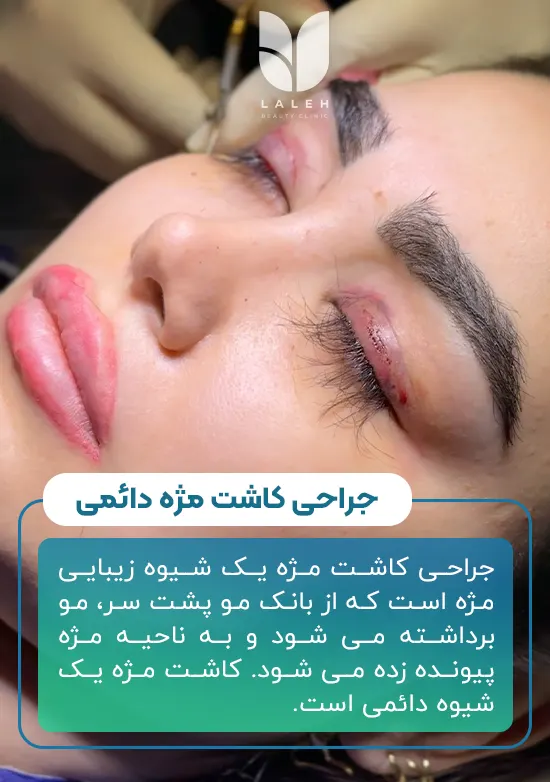 جراحی کاشت مژه دائمی