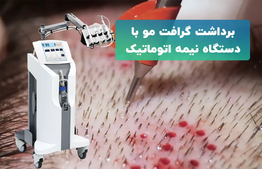 کاشت ابرو به روش SUT