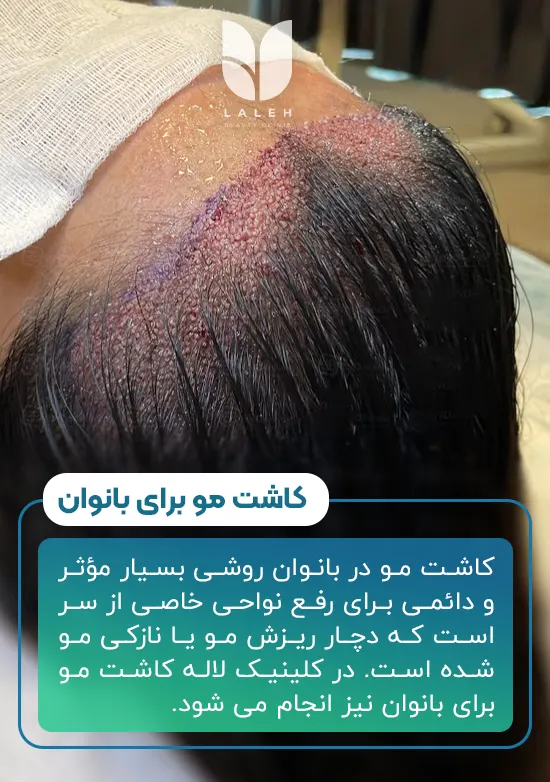 کاشت مو در بانوان