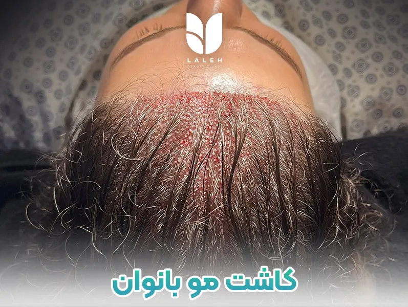 کاشت مو در بانوان