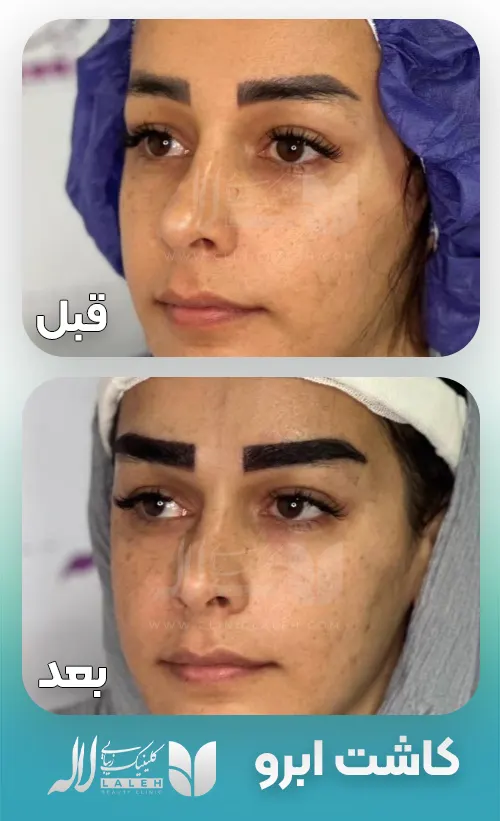 قبل و بعد کاشت ابرو