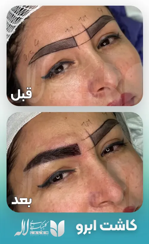 قبل و بعد کاشت ابرو