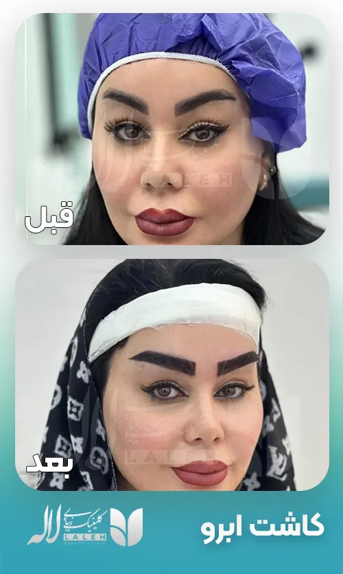 قبل و بعد کاشت ابرو