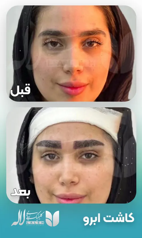 قبل و بعد کاشت ابرو