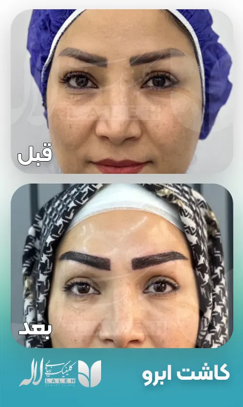 قبل و بعد کاشت ابرو
