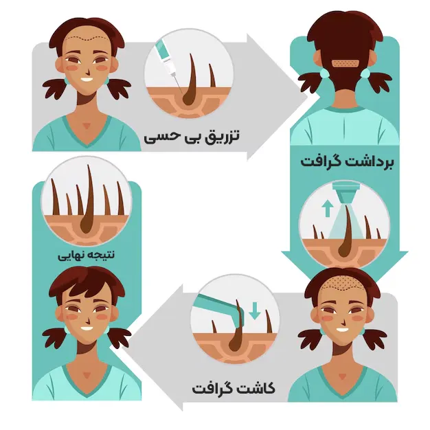کاشت مو در بانوان