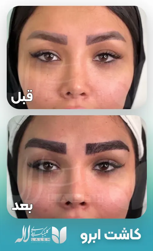 قبل و بعد کاشت ابرو